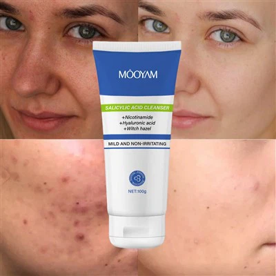 Asid salicylig yn lleihau glanhawr ewyn acne